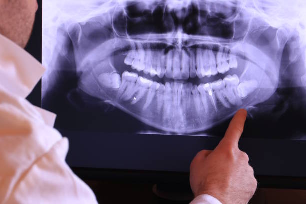 Best Dental Abscess Treatment in Montpelier, OH