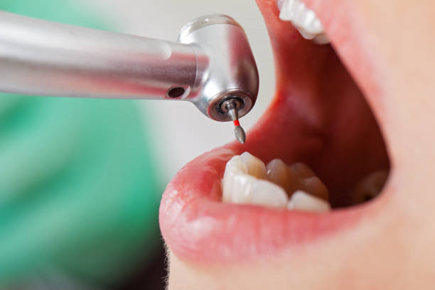 Best Lost Filling or Crown Replacement in Montpelier, OH
